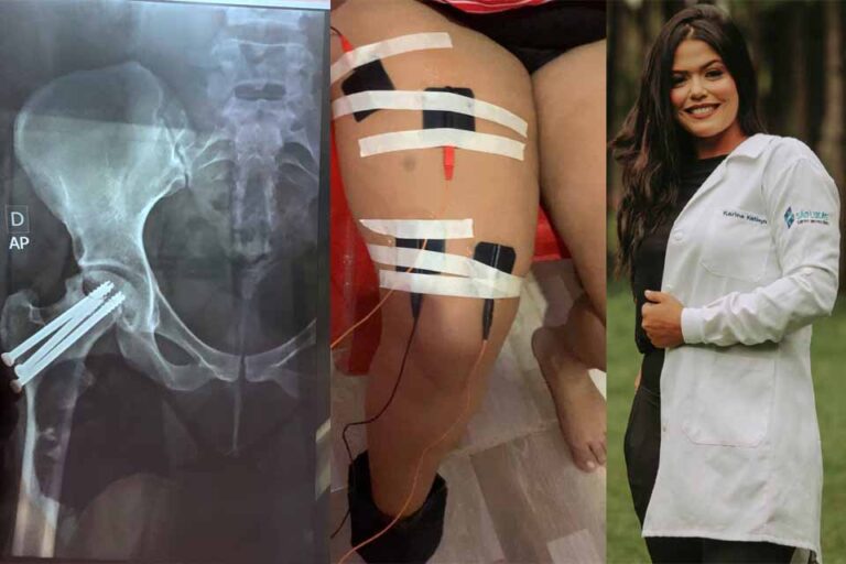 Após cirurgia delicada, fonoaudióloga lança rifa online para tratar necrose no fêmur; saiba como  ajudar
