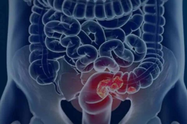 Pacientes com câncer colorretal são diagnosticados em estágio avançado